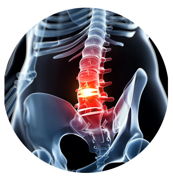 spinal stenosis